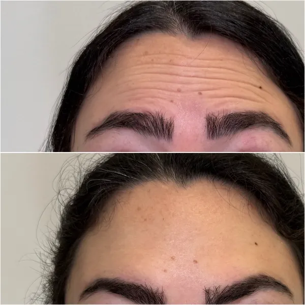 טיפול בוטוקס בקמטי מצח – תמונת לפני ואחרי, L.A Aesthetics נס ציונה